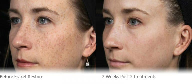 Fraxel Skin Resurfacing Laser Treatment - Cranley Clinic - London