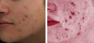 Acne Cranley Clinic