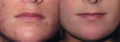 Acne RoAccutane at Cranley Clinic