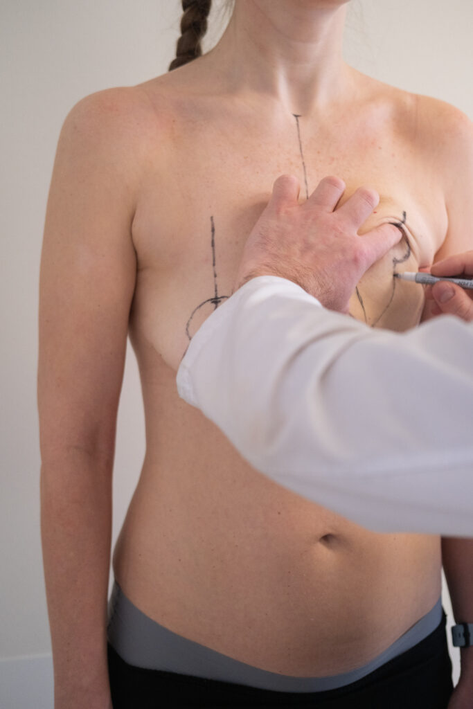Plastic surgeon marking womans breast with pen before surgery, patient standing topless while doctor draws incision lines on chest, medical aesthetic procedure, medical mammoplasty, mastopexy.