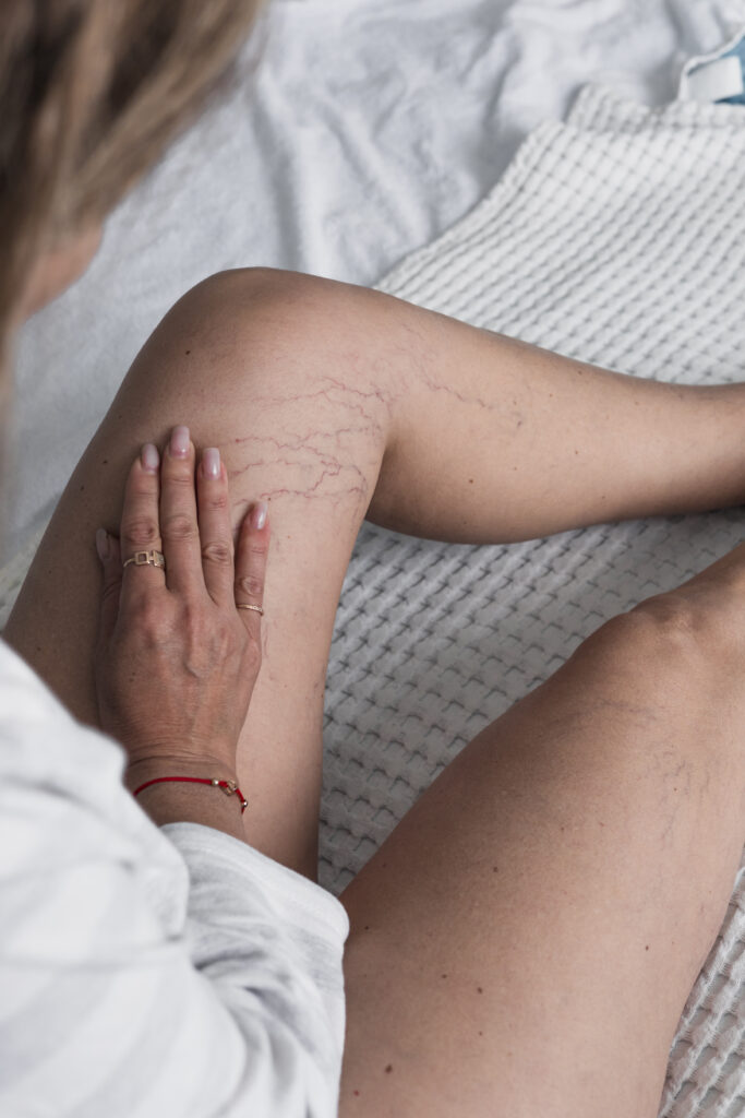 Woman sitting on bed and shows her slim legs with varicosity