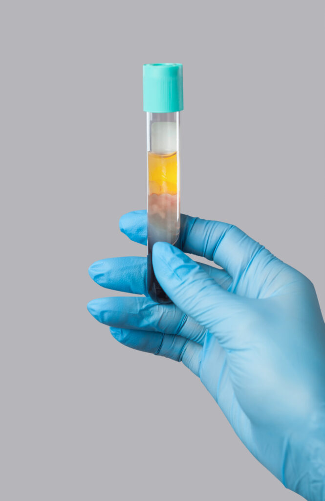 Cosmetologist does prp therapy on the face of a beautiful woman in a beauty salon. There is in vitro blood plasma, ready for injection. Cosmetology concept.