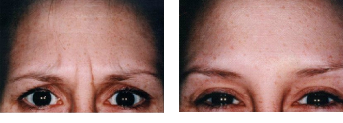 Botox Forehead 1