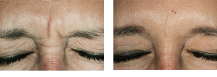 Botox Forehead 2