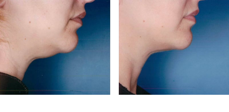 Chin Injection before and after