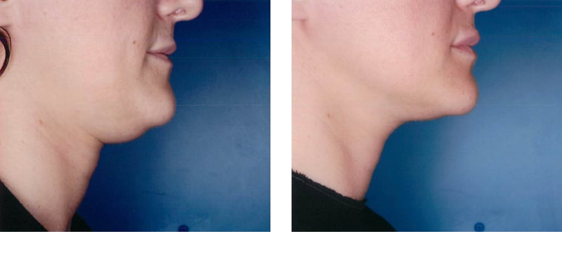 Chin Injection before and after Number 2