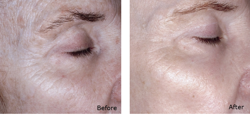 PRP Before and After