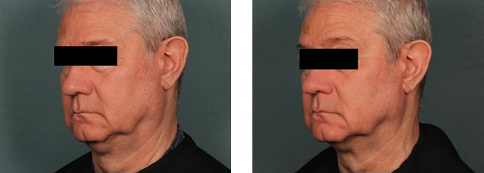 Sofwave Before and After 2