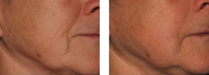 Sofwave Before and After 1