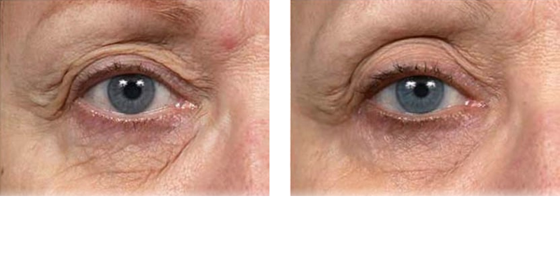 Thermage Eyes