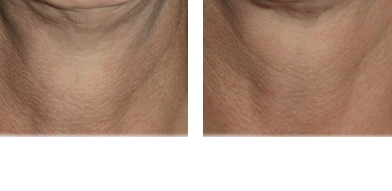 Thermage Neck Treatment