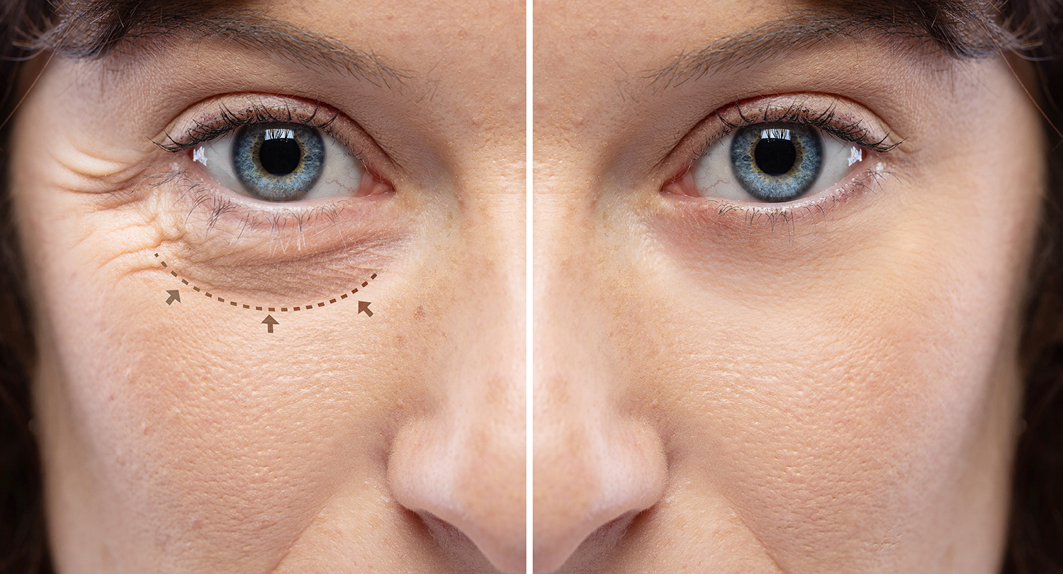 Blepharoplasty: Rejuvenating the Eyes with Precision and Subtlety