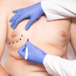 Male Gynecomastia Surgery