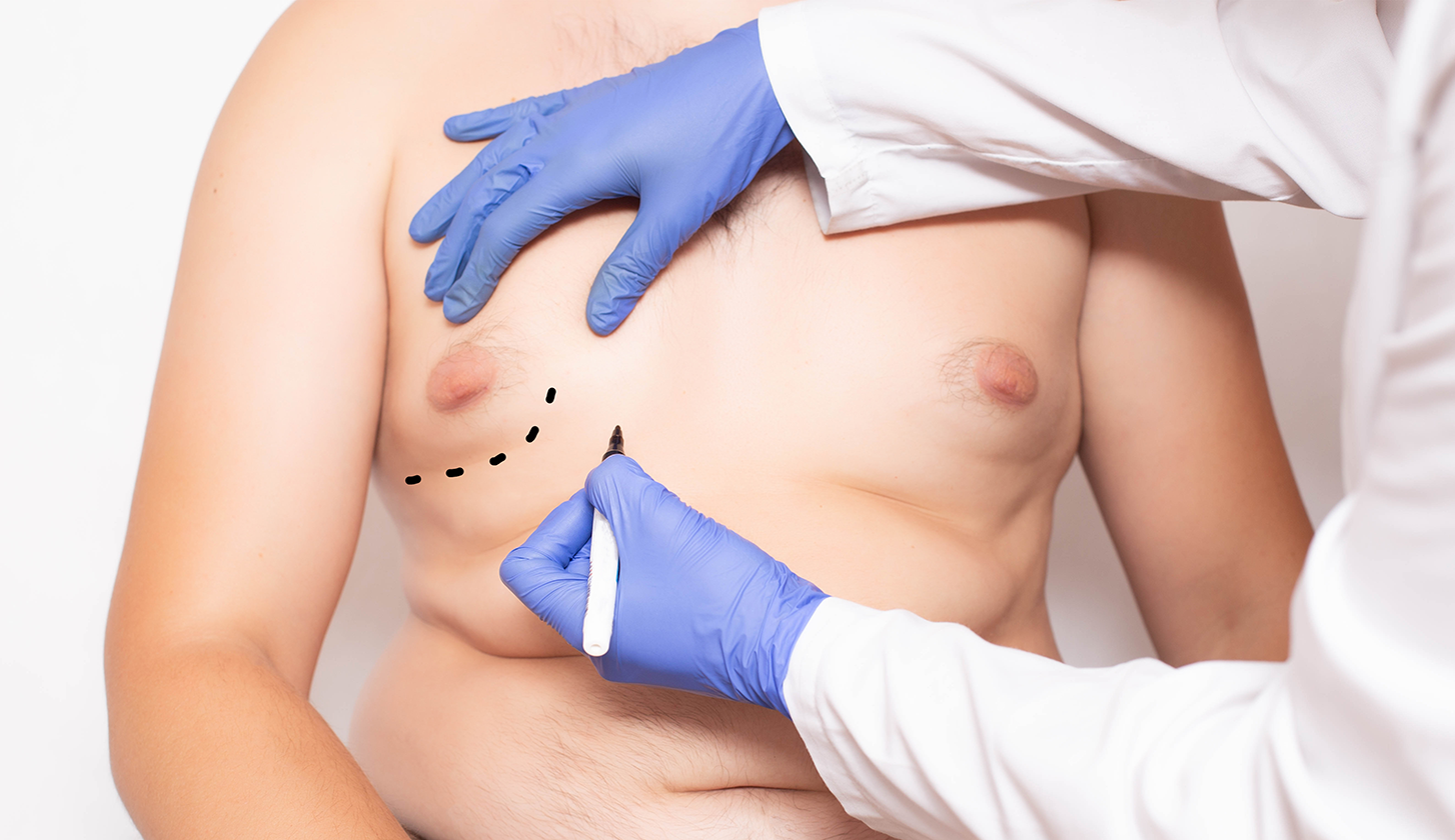 Male Gynecomastia Surgery