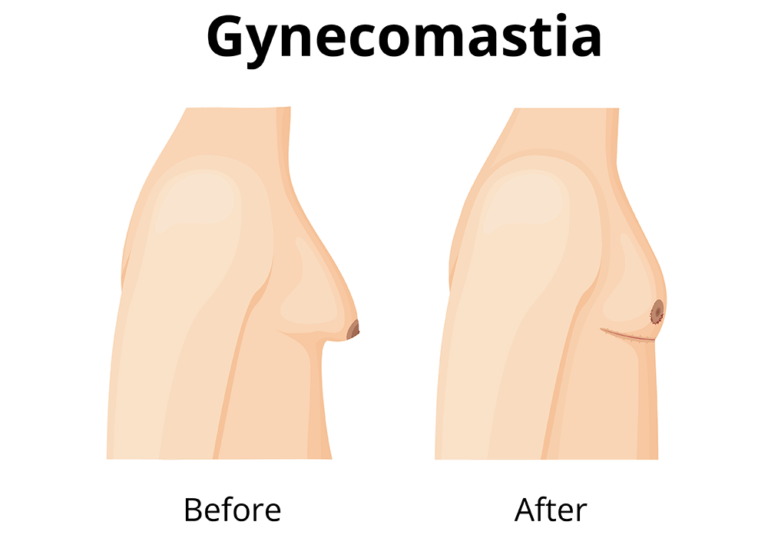 Gynecomastia Before and After
