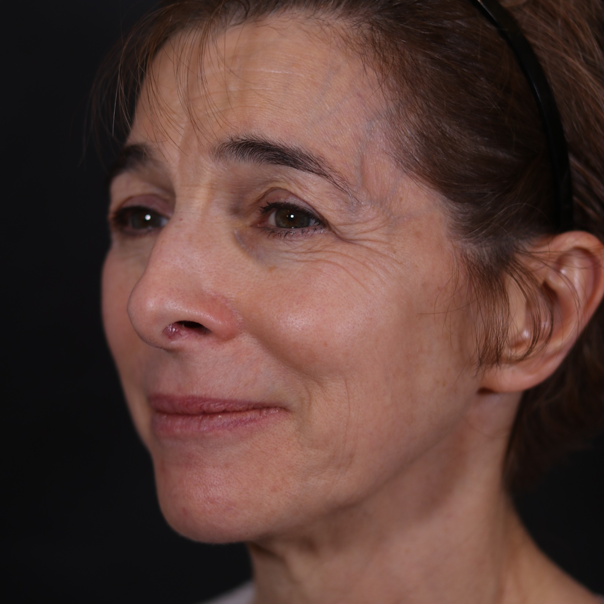 Endoscopic Facelift Womans Face Before