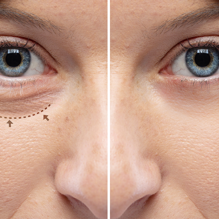 Blepharoplasty: Rejuvenating the Eyes with Precision and Subtlety